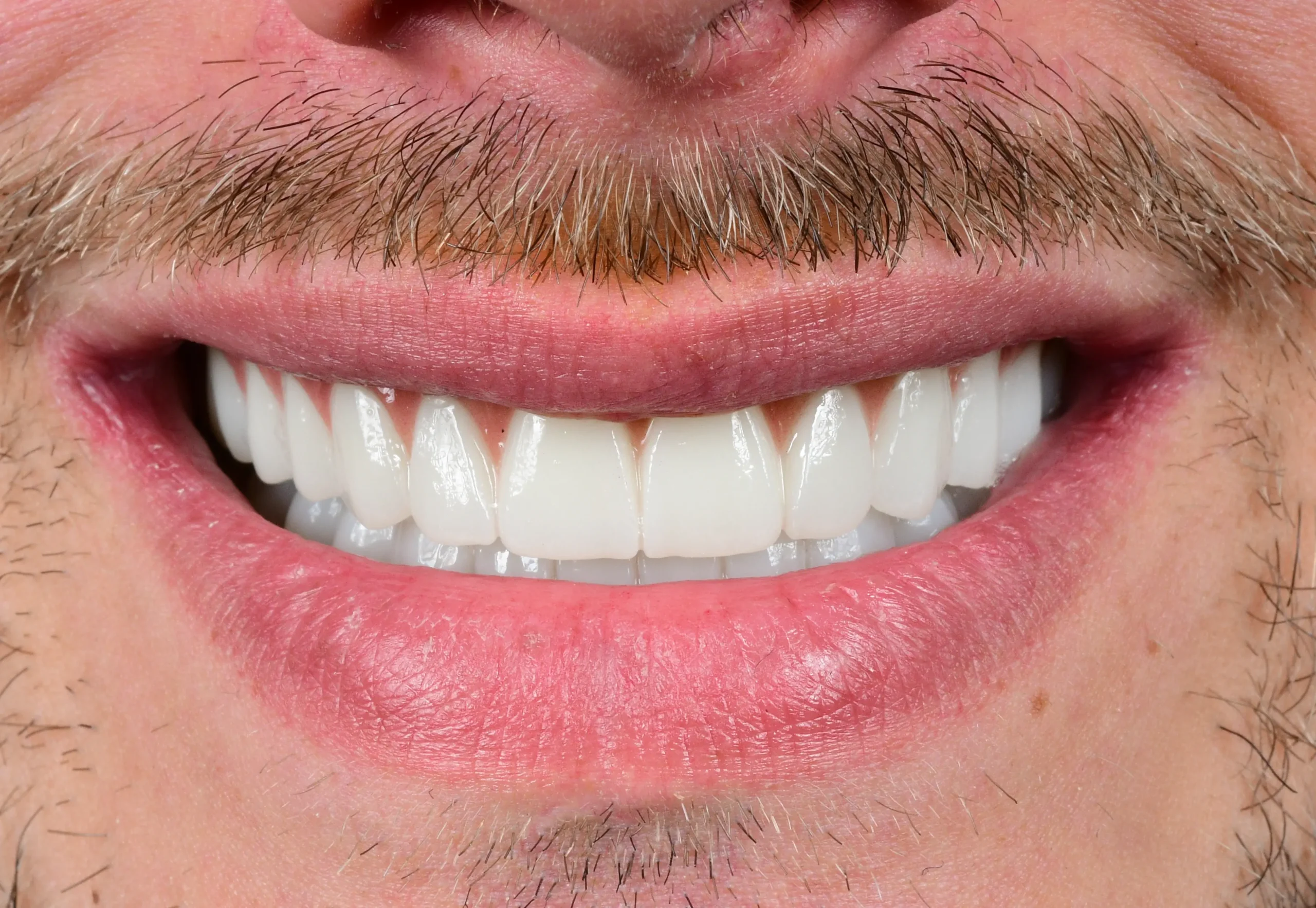 All On 6 Treatment — After