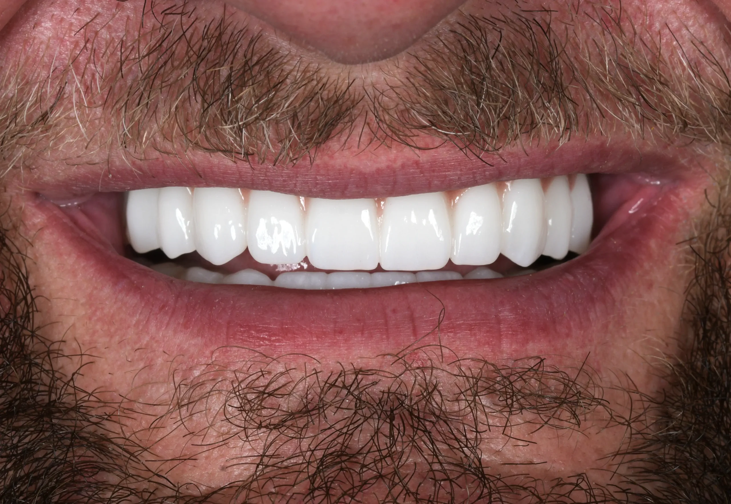 All On 4 Treatment — After